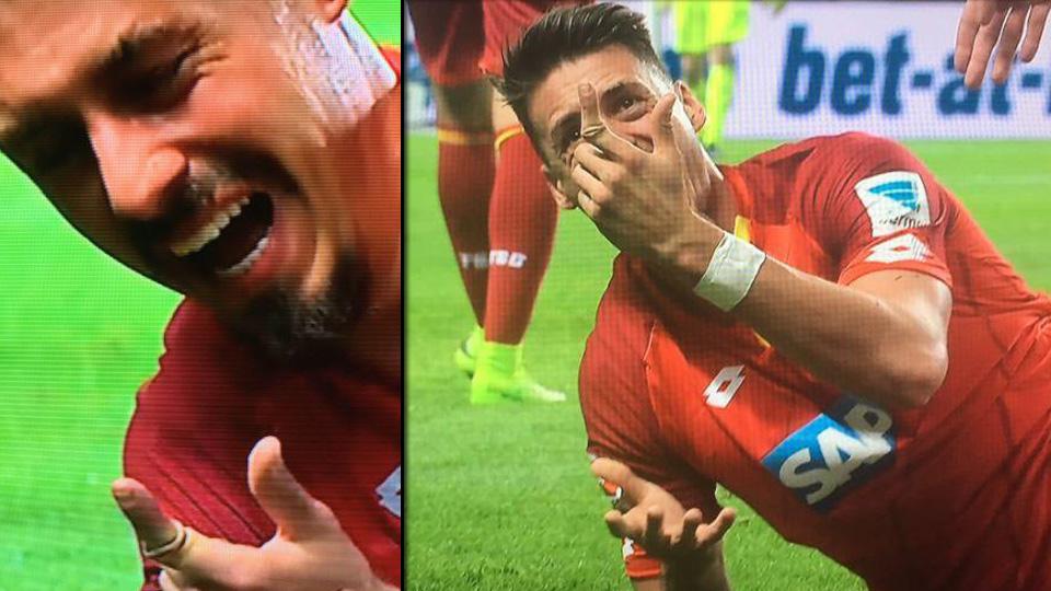 Striker Hoffenheim, Sandro Wagner memperlihatkan kondisi jari telunjuknya yang patah. - INDOSPORT
