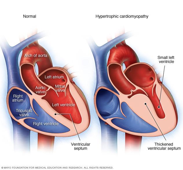 Penyakit jantung bernama Hypertrophic Obstructive Cardiomyopathy, membuat dinding jantung menebal. Copyright: Internet/mayoclinic.org