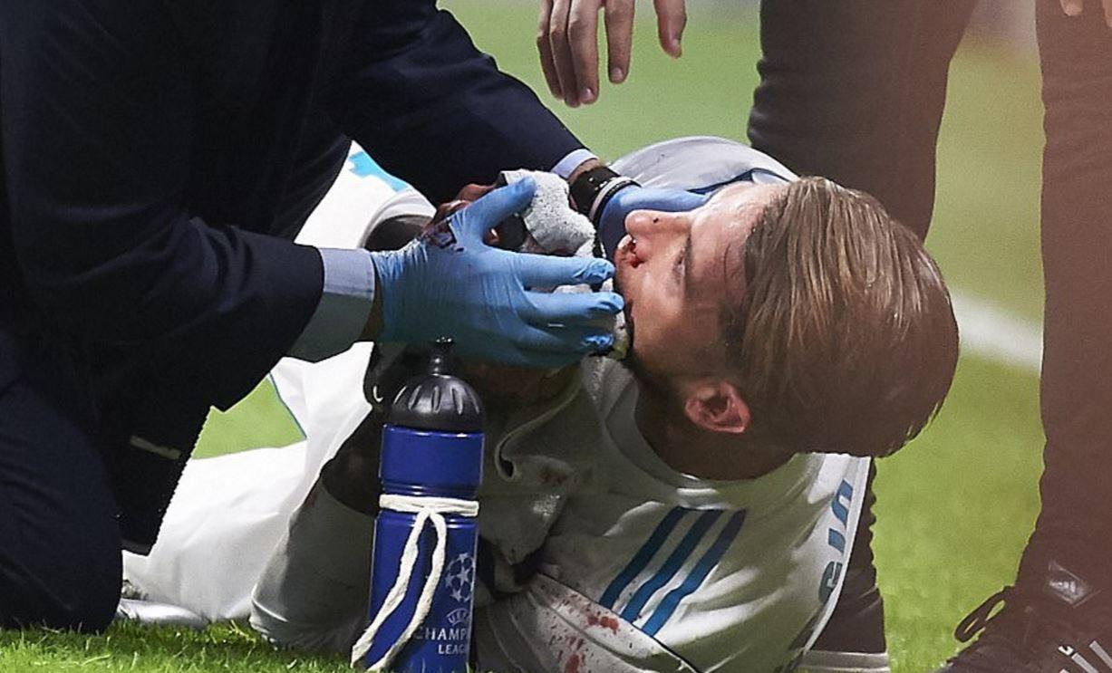 Ramos sedang mendapat perawatan medis akibat pendarahan pada hidungnya Copyright: Internet