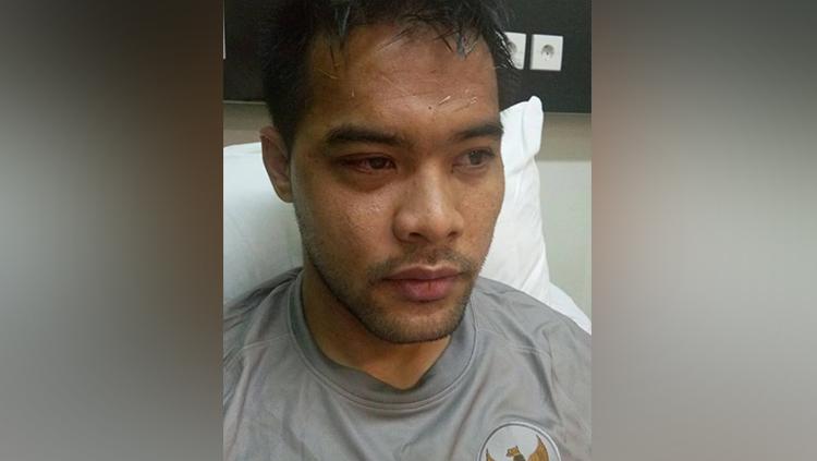 Andritany Ardhiyasa mengalami lebam di mata kanannya. - INDOSPORT