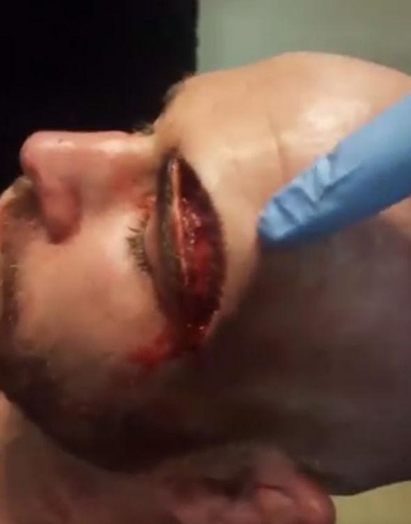 Kepala petarung MMA Jack Mason, yang luka seperti di silet Copyright: Express.co.uk