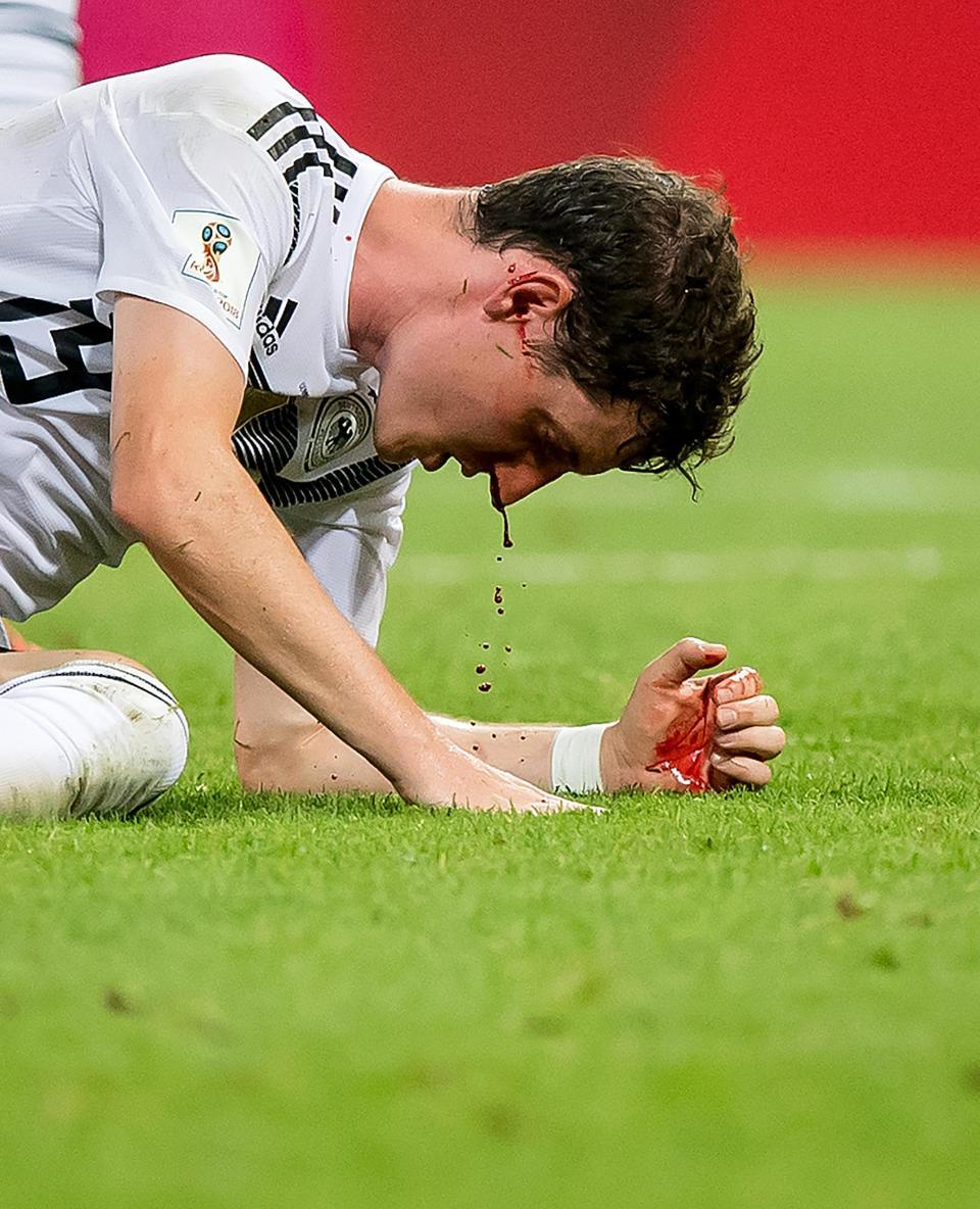 Gelandang Jerman, Sebastian Rudy yang Mengalami Patah Hidung Copyright: The Sun