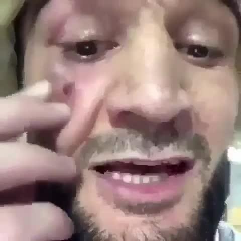 Sepupu Khabib, Abubakar, menunjukkan luka lebab di wajahnya akibat pukulan McGregor Copyright: The Sun