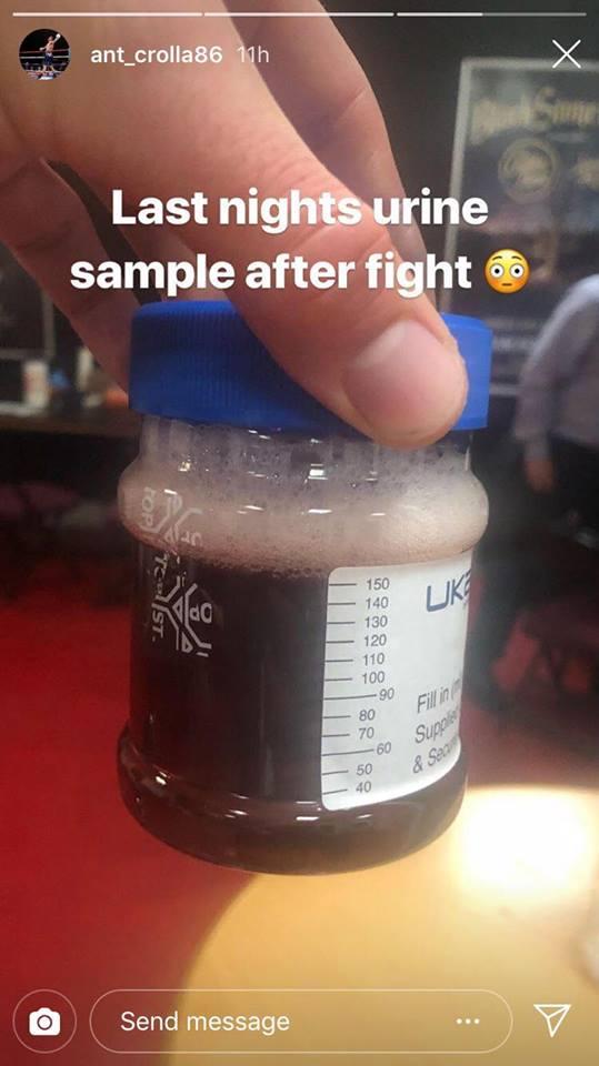 Sampel urin Anthony Crolla yang sangat pekat seusai pertandingan melawan Daud Yordan Copyright: Instagram/@ant_crolla86