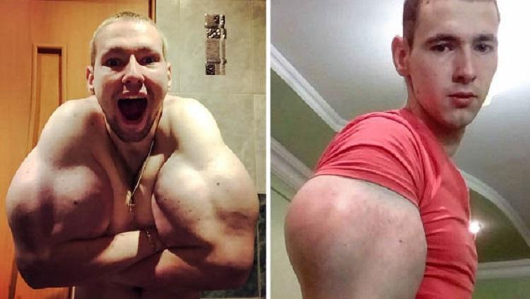 Kirill Tereshin, binaragawan yang terancam cacat