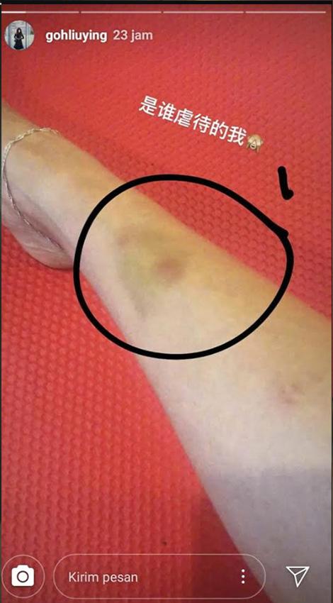 Betis pebulutangkis cantik Malaysia, Goh Liu Ying, memar usai berlaga di All England. Copyright: instastory@guhliying