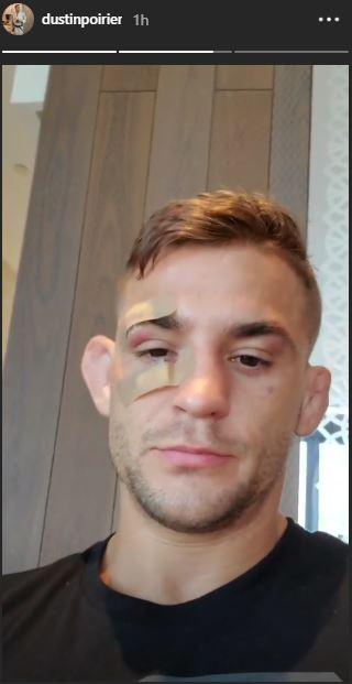 Dustin Poirier Tunjukkan Kondisi Wajah Usai Rasakan Keganasan Khabib Copyright: instagram.com/dustinpoirier