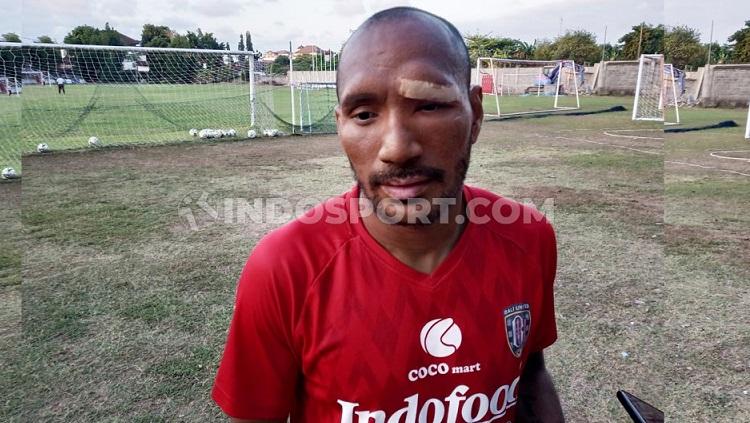 Pelipis kiri Leonard Tupamahu terlihat masih ditutup perban usai mendapat 12 jahitan. Foto: Nofik Lukman Hakim