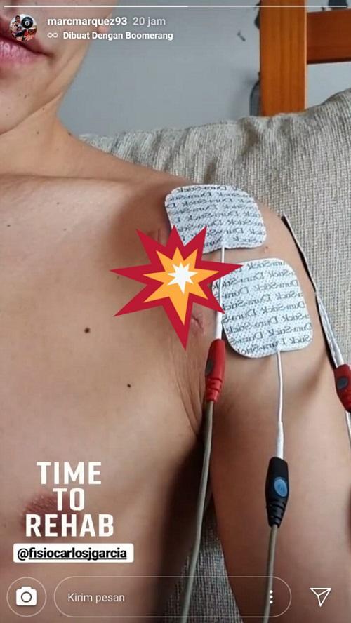 Marc Marquez membeberkan kondisi terkininya setelah menjalani operasi. Copyright: Instagram @marcmarquez93