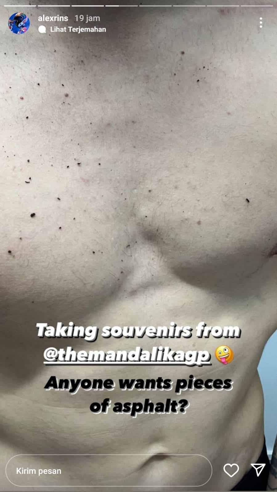 Tubuh Alex Rins yang dipenuhi bekas krikil usai balapan di MotoGP Mandalika. Foto: Instastory@alexrins Copyright: Instastory@alexrins