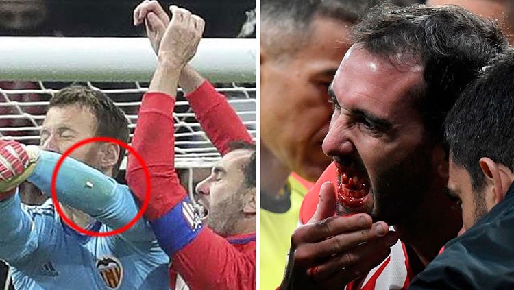 Rontoknya gigi Diego Godin. Copyright: &copy; Getty Images