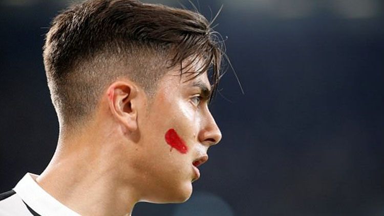 Paoulo Dybala menggunakan strip merah di pipinya. Copyright: © Daily Mail
