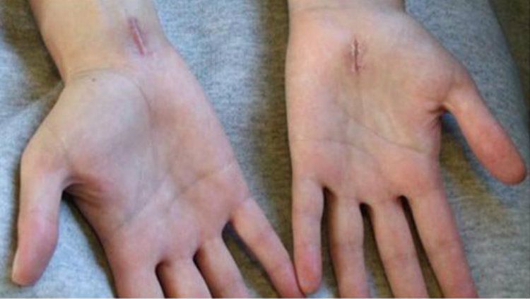 Carpal Tunnel Syndrome. Copyright: &copy; Helo Sehat
