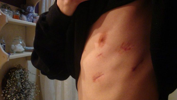 Spontaneous Pneumothorax atau Collapsed Lung Copyright: &copy; Natecow