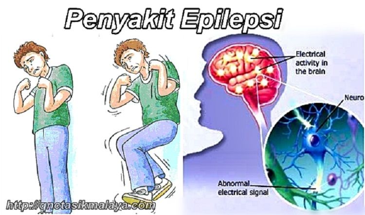 Ilustrasi Epilepsi. Copyright: &copy; Getty Images
