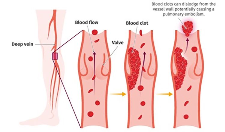 Ilustrasi Thrombosis. Copyright: &copy; Getty Images