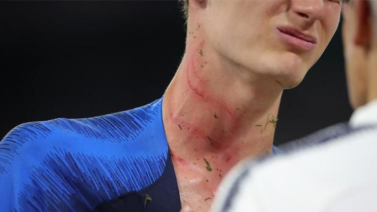 Kondisi Leher Benjamin Pavard Setelah Berduel dengan Antonio Rudiger Copyright: © ESPN