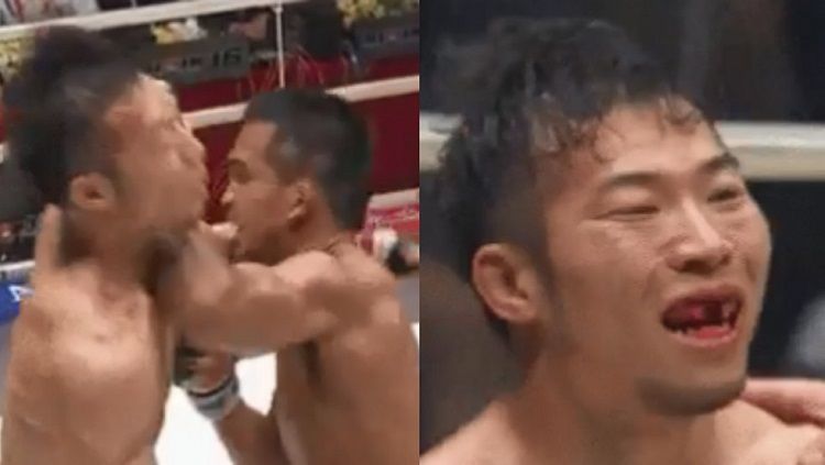 Petarung MMA Jepang, Yusaku Nakamura memerlukan penanganan gigi yang lumayan serius akibat hantaman siku dari Thanongsaklek Chuwattana. Copyright: © RT Sport