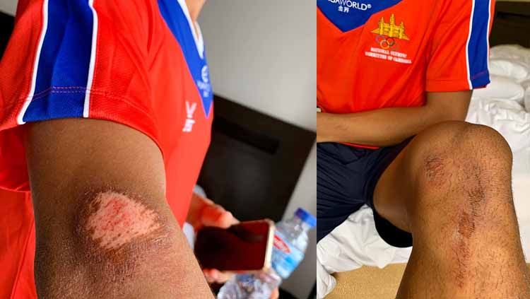 Pemain Timnas sepak Kamboja mengalami luka mengerikan saat bertanding melawan tuan rumah Filipina di Stadion Rizal Memorial, Manila, Filipina pada ajang SEA Games 2019 Filipina. Copyright: © https://www.foxsportsasia.com/