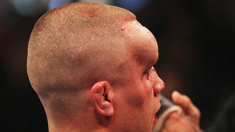 Petarung Mixed Martial Arts (MMA), Mark Hominick mendapatkan cedera hematoma sebesar bola ping-pong usai kalah dari Jose Aldo Copyright: © Al Bello/Zuffa LLC/Zuffa LLC via Getty Images